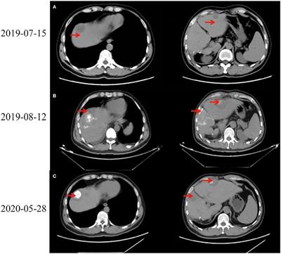 A Patient With Failed Liver Transplantation After the Use of PD-1 Blockade Combined With Lenvaxen